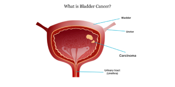Bladder Cancer and type