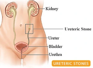 kidney-stone