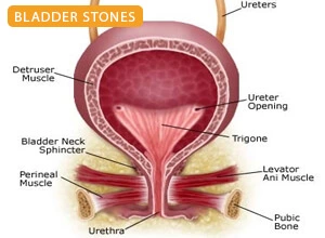 Best Bladder Cancer Surgeon in Patna