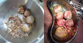 Bladder stone